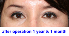 plastic-surgery-blepharoplasty